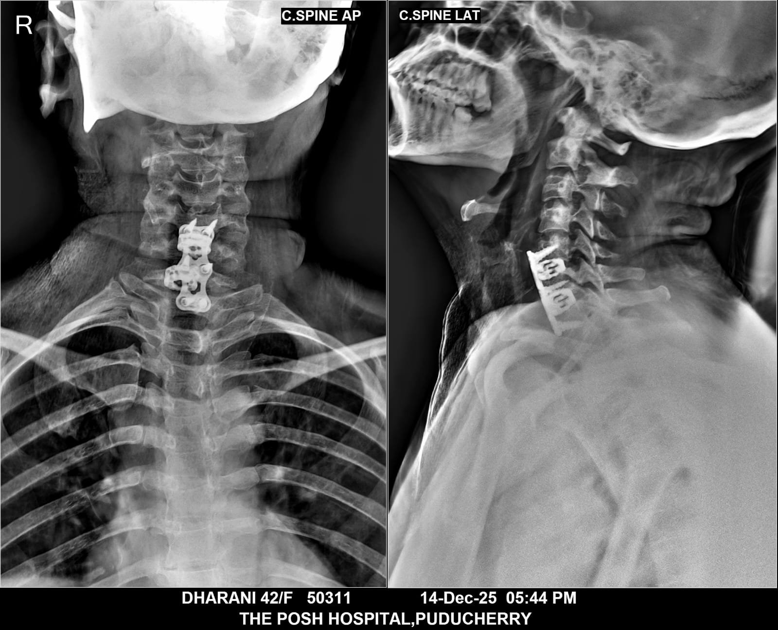 ACDF Cervical Surgery Case